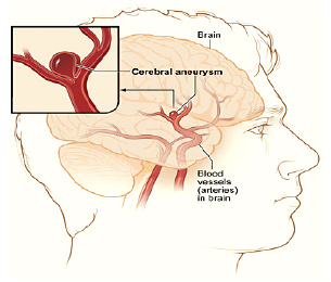 Craniotomy & Clipping of Anterior Cerebral Aneurysm