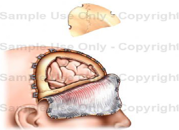 Craniotomy & Repair of Anterior Cranial Fossa Floor