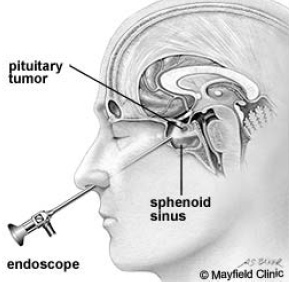 Transsphenoidal Removal for Pituitary Tumour