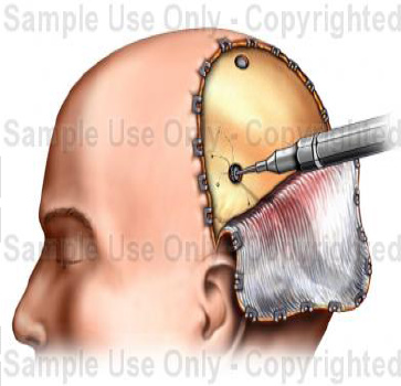 Burr Holes for Haematoma