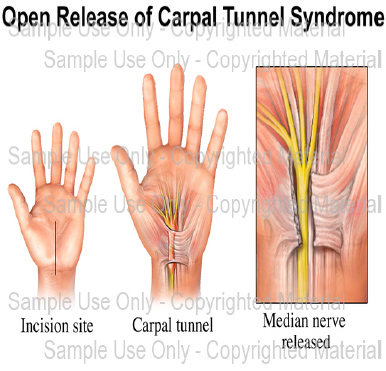 Carpal Tunnel Release