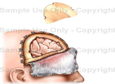 Craniotomy for Evacuation of Intracranial Haematoma