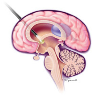 Endoscopic Procedure & +/- Endoscopic Third Ventriculostomy