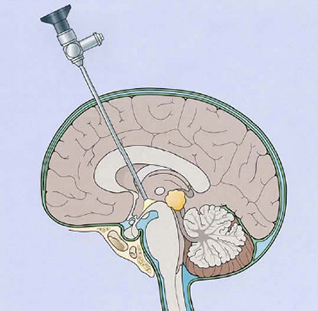 Endoscopic Procedure & +/- Endoscopic Third Ventriculostomy