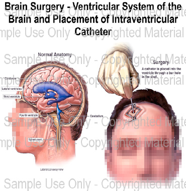 Insertion of External Ventricular Drain