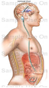 Insertion of Ventricular Shunt