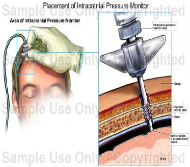 Intracranial Pressure Monitoring