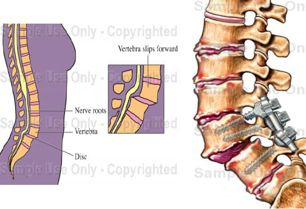 Lumbar Decompression & Pedicle Screw Instrumented Fusion for Spondylolisthesis