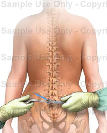 Minimally Invasive Decompression for Lumbar Canal Stenosis